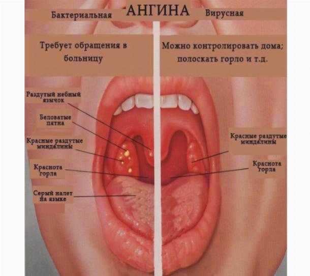 Болит горло без температуры это коронавирус или орви: может быть или нет, заложен нос, болит голова, чихание, сопутствующие симптомы