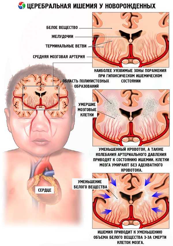 Что такое церебральная ишемия у новорожденного