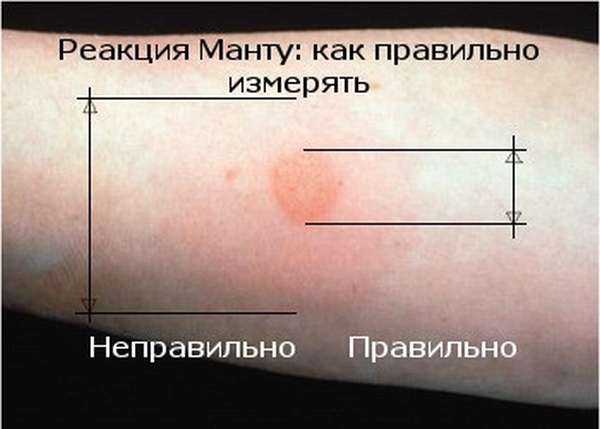 Аллергия на манту