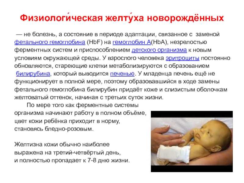 Физиологическая желтуха новорожденных - роддом "лелека"