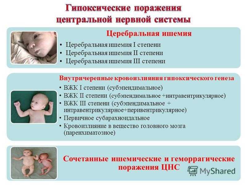 Церебральная ишемия у новорожденных 1, 2, 3 степени: причины, симптомы, последствия, лечение