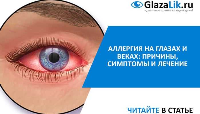 Как подобрать противоаллергические капли для глаз? «ochkov.net»