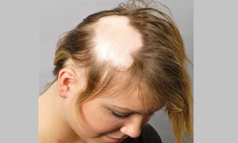 Сильное выпадение волос у женщин – причины, способы лечения волос