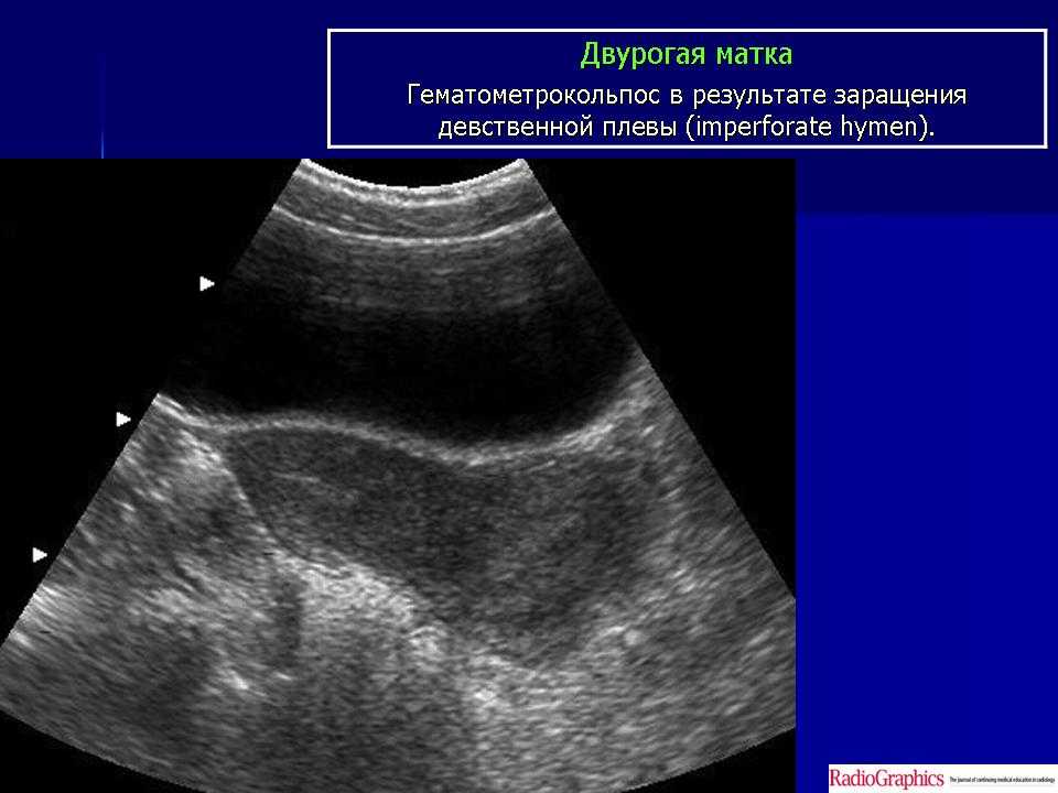 Медикаментозный аборт у пациенток с рубцом на матке
 - vmc verte medical clinic
