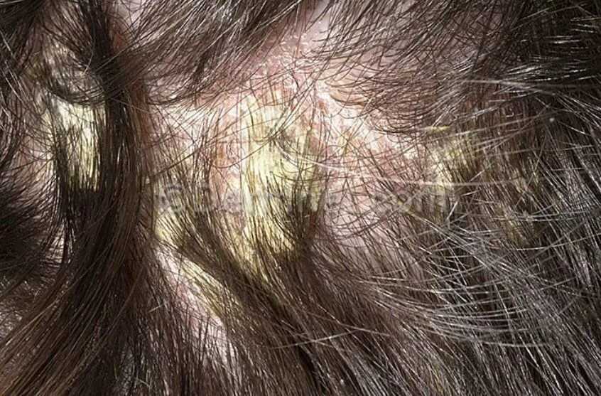 Могут ли выпадать волосы из-за пищевой аллергии