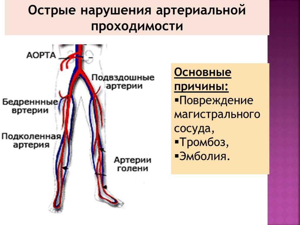 Тромбоз подвздошной вены. Острое нарушение кровообращения нижних конечностей. Нарушение артериального кровообращения нижних конечностей. Острое нарушение артериальной проходимости. Острые тромбоэмболии артерий конечностей.