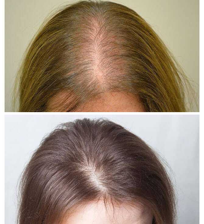 Лечение выпадения волос у женщин после 30