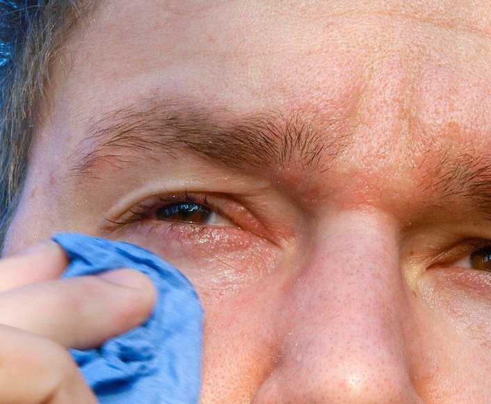 Какие выбрать капли для глаз при аллергии?