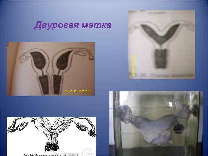 Двурогая матка | симптомы | диагностика | лечение - docdoc.ru