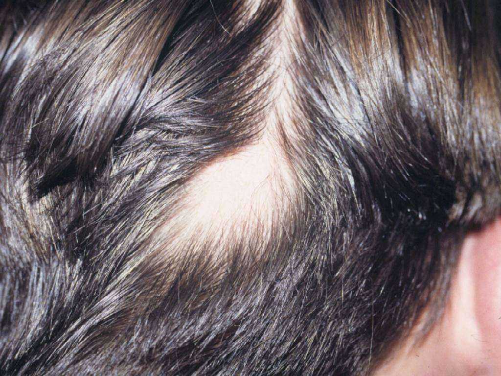 Выпадение волос у женщин после 30: причины, лечение, с чем связано?