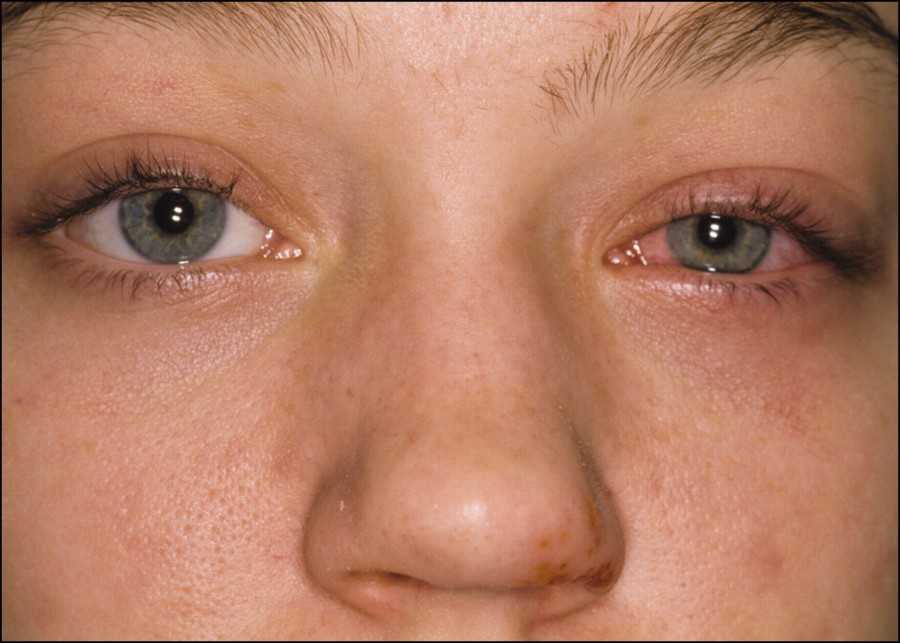 Аллергия на глазах: возможные причины