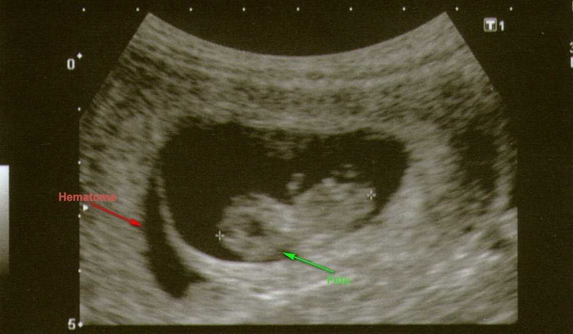 Ретрохориальная гематома при беременности на ранних сроках (7-12 неделя): последствия для ребенка
