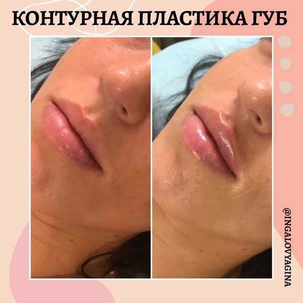 Как долго действуют дермальные наполнители - филлеры, и что ждать от их введения - клиника косметологии