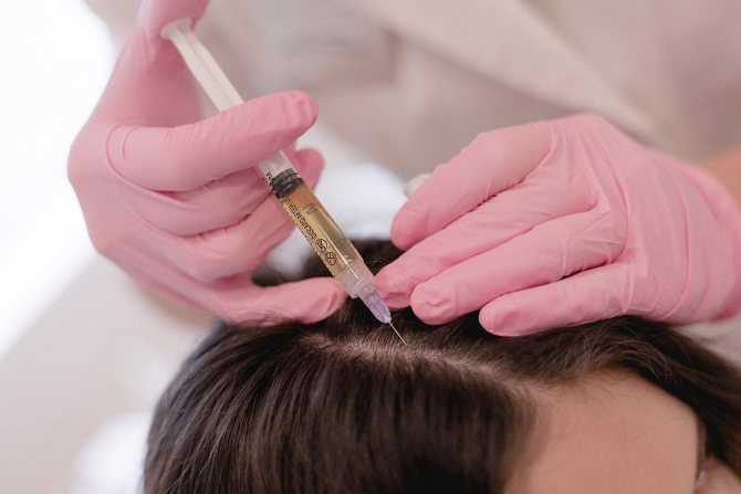 Барнаульский дерматолог рассказала о массивном выпадении волос после коронавируса