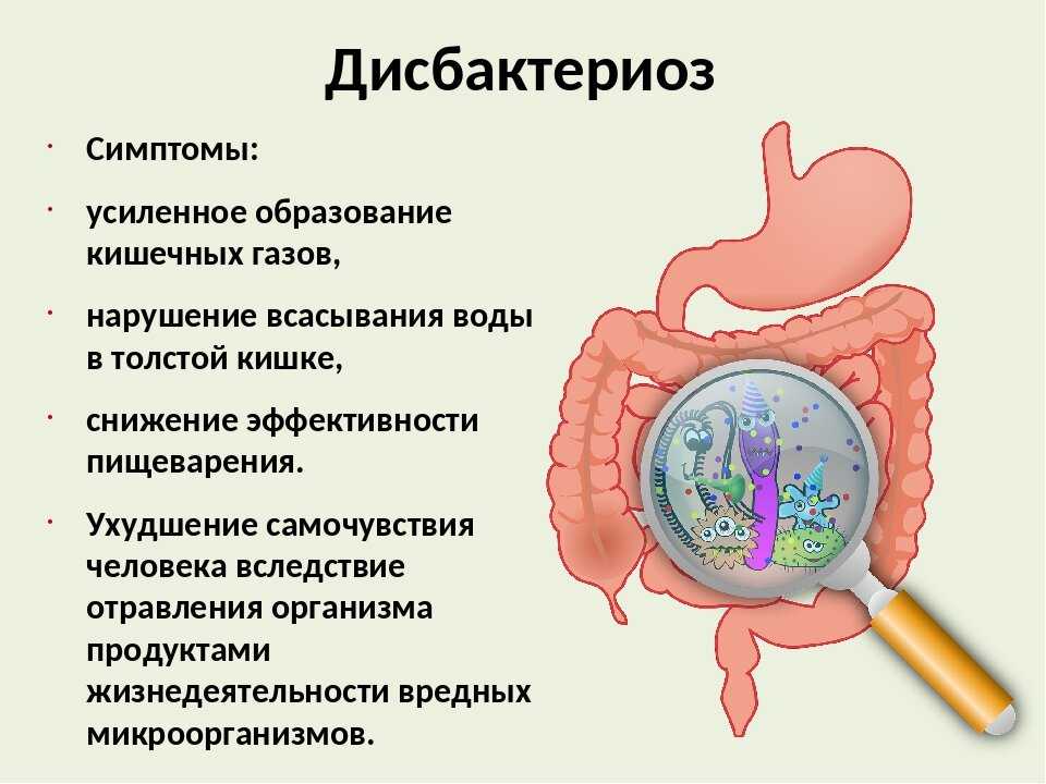 Дисбактериоз