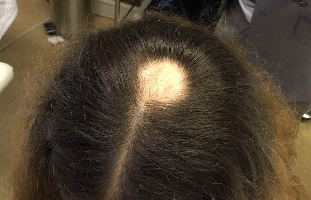 Дигидротестостерон – гормональная причина выпадения волос