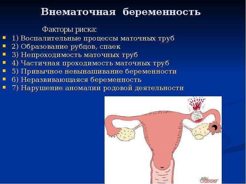 Забеременеть после внематочной беременности с одной трубой. Внематочная беременность. Внематочная беременнос. Внематочная беременность симптомы. Причины внематочной беременности.