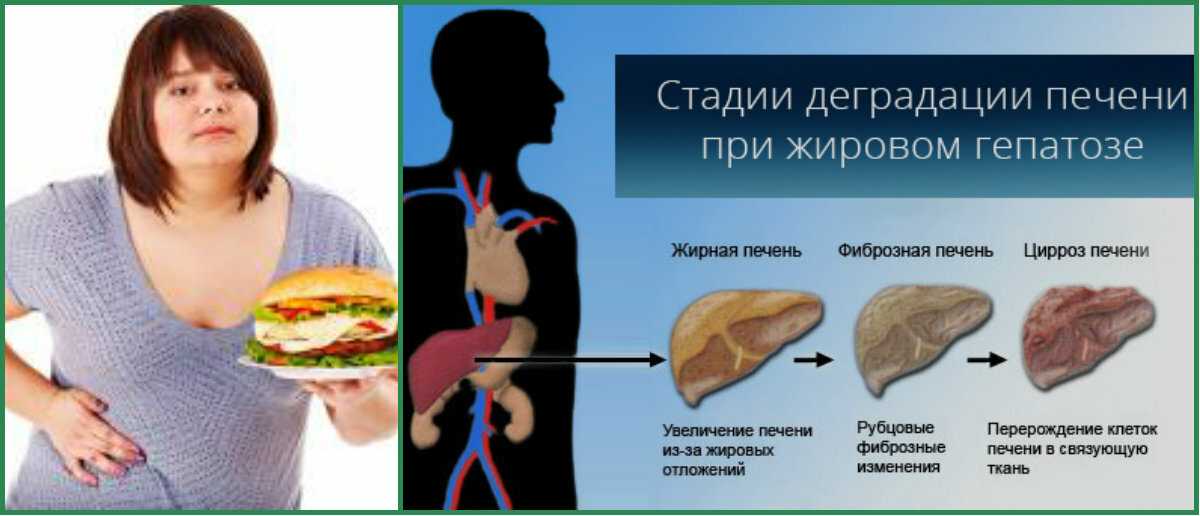 Препараты от жирового гепатоза печени: гепатопротекторы в лечении жирового гепатоза