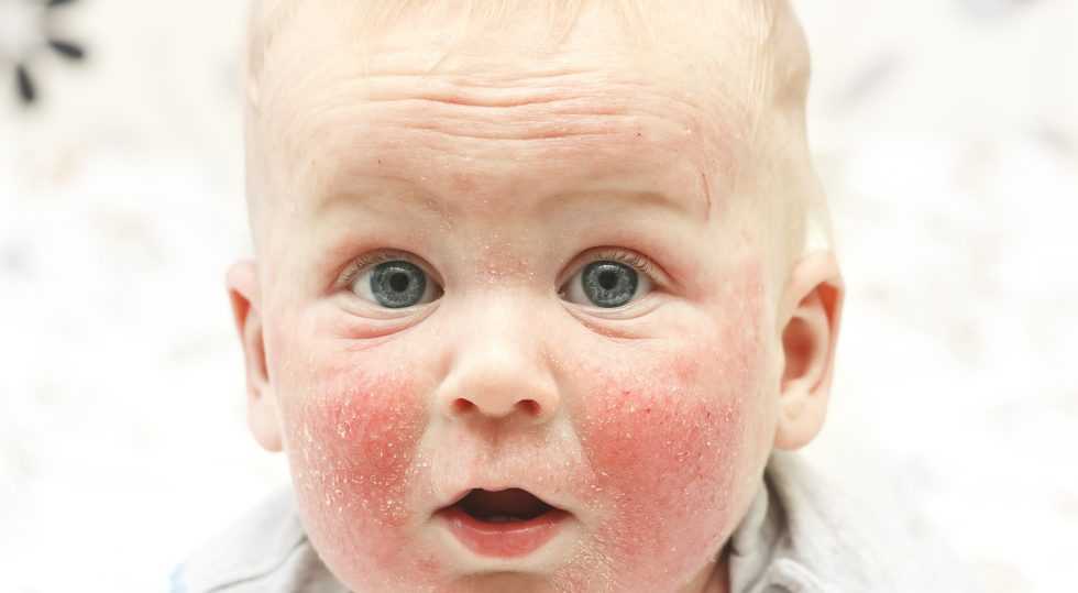 Аллергия у детей: симптомы, развитие, лечение | "сенситив"