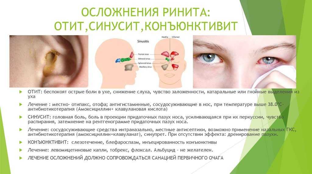 Аллергический ринит – гбоу «никио им. л.и. свержевского» департамента здравоохранения города москвы