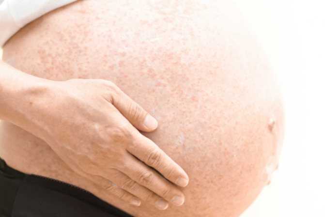 Беременность и болезни кожи