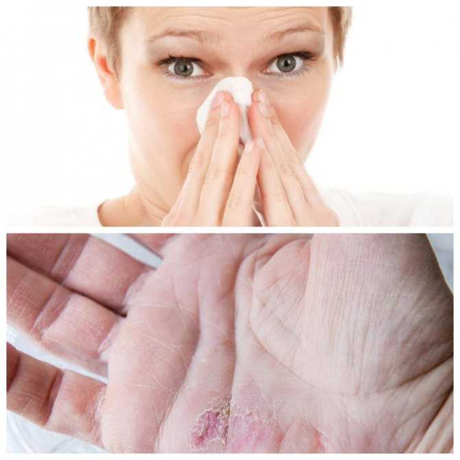 Аллергия на стиральный порошок: фото, отзывы, как выглядит, симптомы