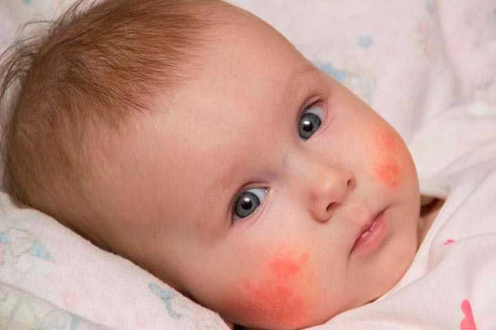 Лекарственная аллергия у детей - симптомы болезни, профилактика и лечение лекарственной аллергии у детей, причины заболевания и его диагностика на eurolab