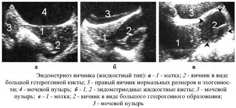 Болит яичник во время беременности. Кисты яичников классификация УЗИ. Эндометриоз яичников на УЗИ. Эндометриоидная киста шейки матки на УЗИ. УЗИ диагностика эндометриоидной кисты.
