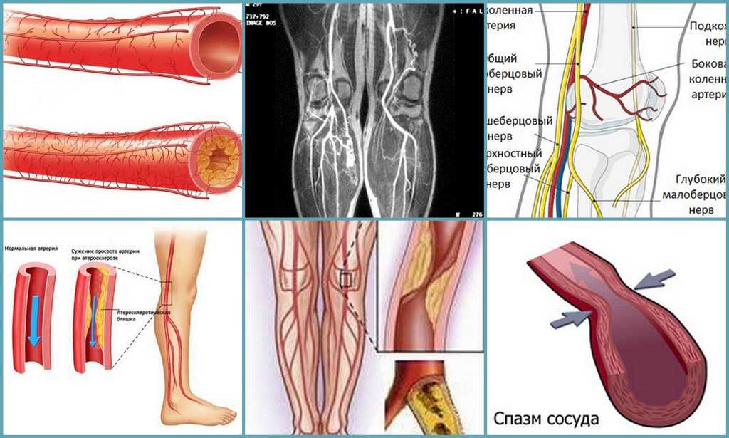 Тромбоз артерии лечение. Облитерирующий атеросклероз сосудов нижних конечностей. Облетерический атеросклероз и эндартериит. Облитерирующий атеросклероз сосудов ног. Облитерирующий атеросклероз голени.