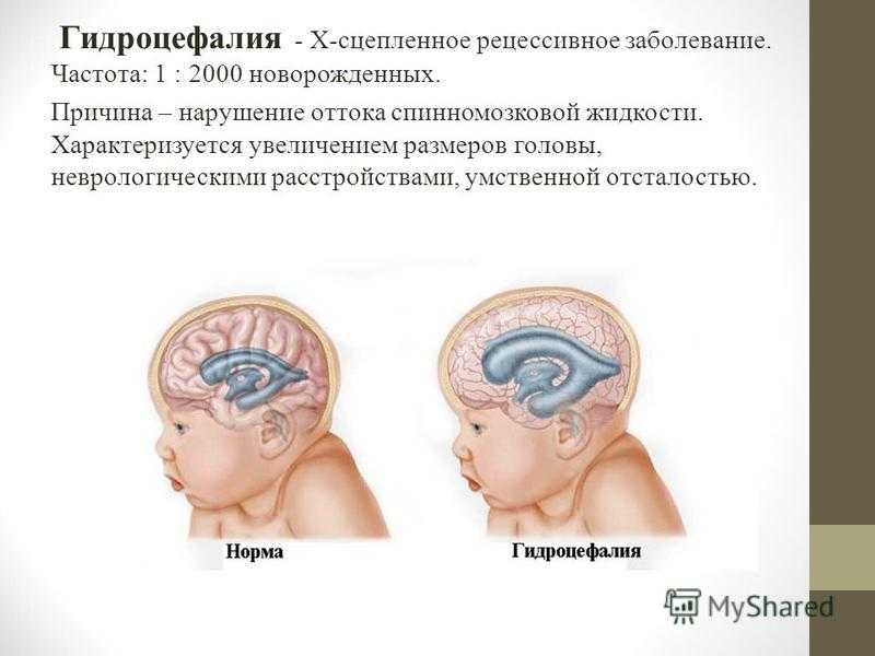 Гидроцефалия у новорожденных. Гидроцефалия головного мозга у ребенка. Гидроцефалия головного мозга у взрослого.