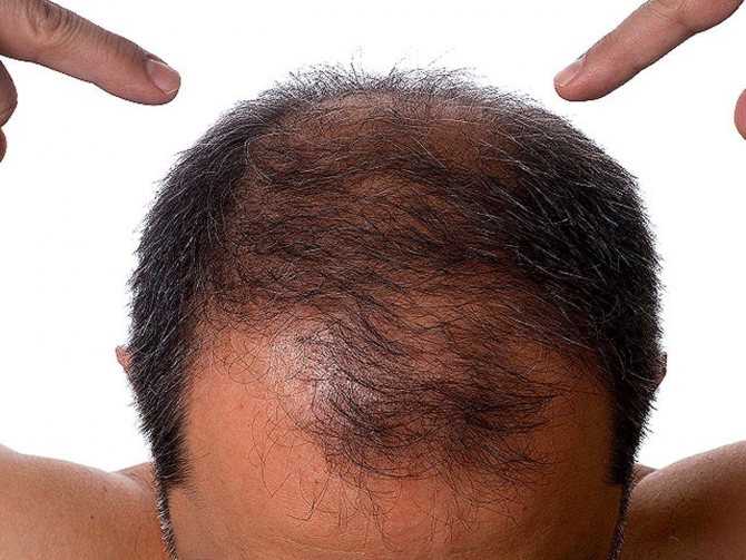 Андрогенная алопеция - это выпадение волос, вызванное одной из следующих причин: избыточное содержание мужского полового гормона дигидротестостерона (дгт); повышенная чувствительность волосяных фолликулов к дгт; повышенная активность фермента 5альфа -реду