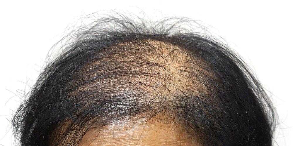 Возрастное выпадение волос у женщин. влияние менопаузы, климакса