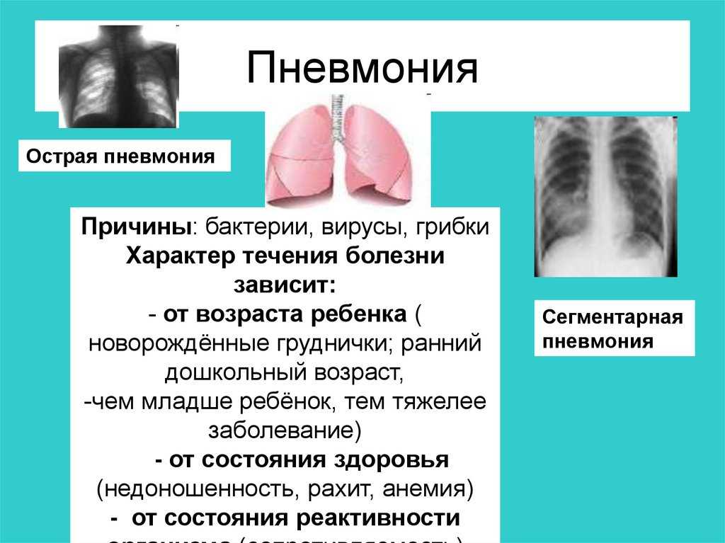 Пневмония у новорожденных - интернет-журнал «pro здоровье» 🏥