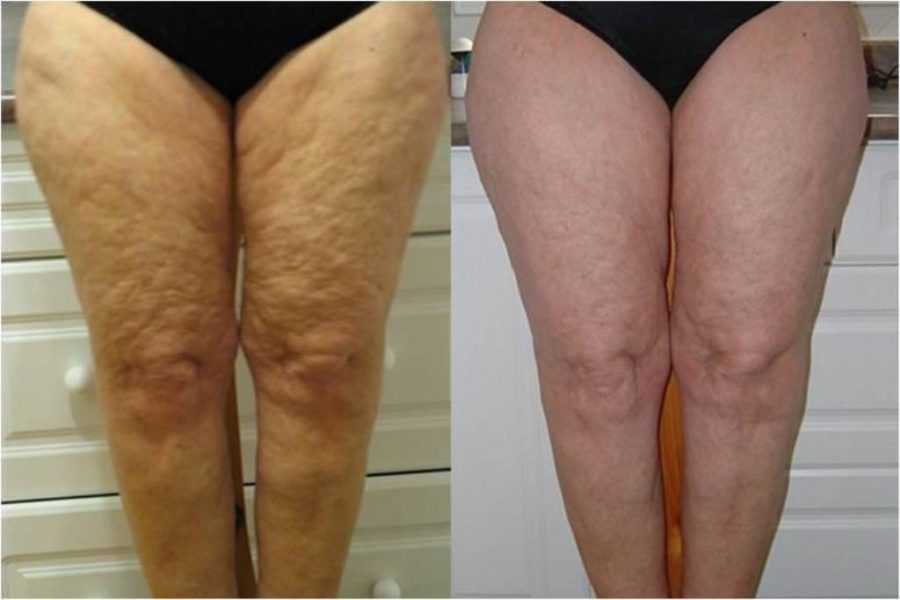 В целом, дряблая кожа на ногах является серьёзной проблемой для многих женщин, как в возрасте, так и совсем молодых.