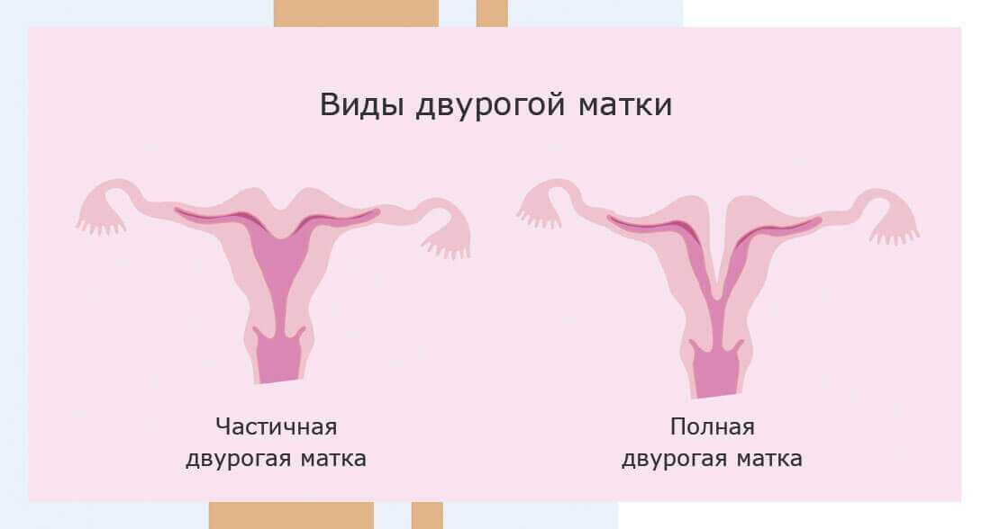 Двурогая матка у женщин, ведение беременности
