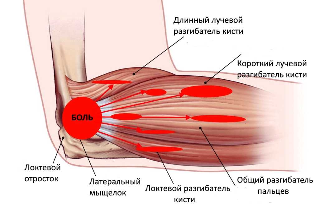 Латеральный эпикондилит локтевого сустава симптомы и лечение фото