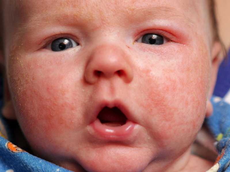 Аллергическая сыпь у детей - причины возникновения, виды и методы лечения