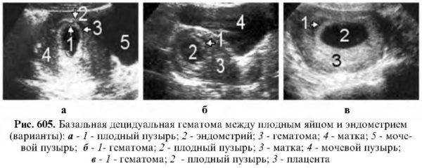 8 акушерская неделя беременности, определяемая по дню начала последней менструации, которая предшествовала оплодотворению, завершает вторую стадию внутриутробного развития - период эмбриогенеза.