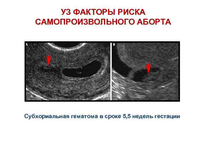 Ретрохориальная гематома при беременности на ранних сроках - детская клиническая больница г. улан-удэ