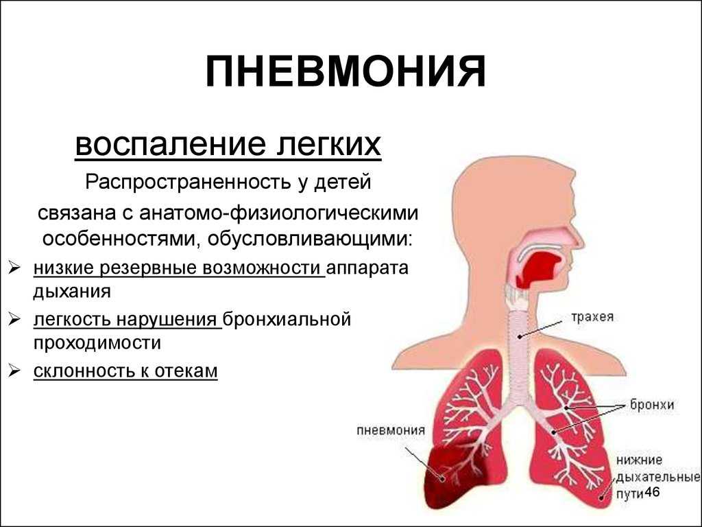 Пневмония у детей до года - причины, симптомы, диагностика, лечение и профилактика