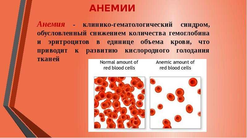 Системная анемия