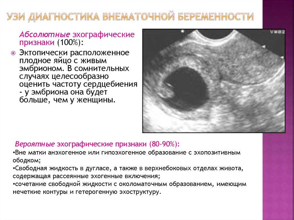 Внематочная беременность: симптомы и признаки – напоправку