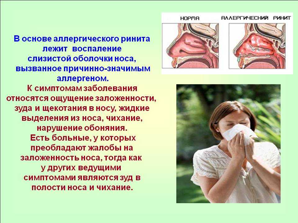 Лекарственная аллергия