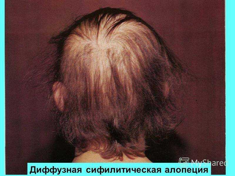 При каких заболеваниях происходит выпадение волос?