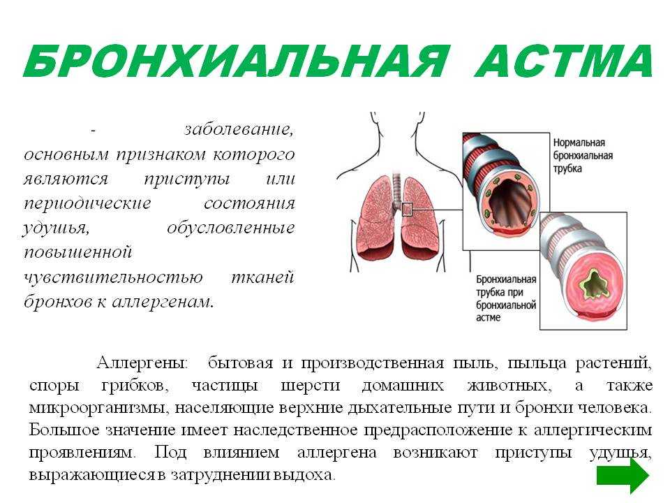 Виды и лечение симптомов аллергии: ринита, бронхиальной астмы и других проявлений