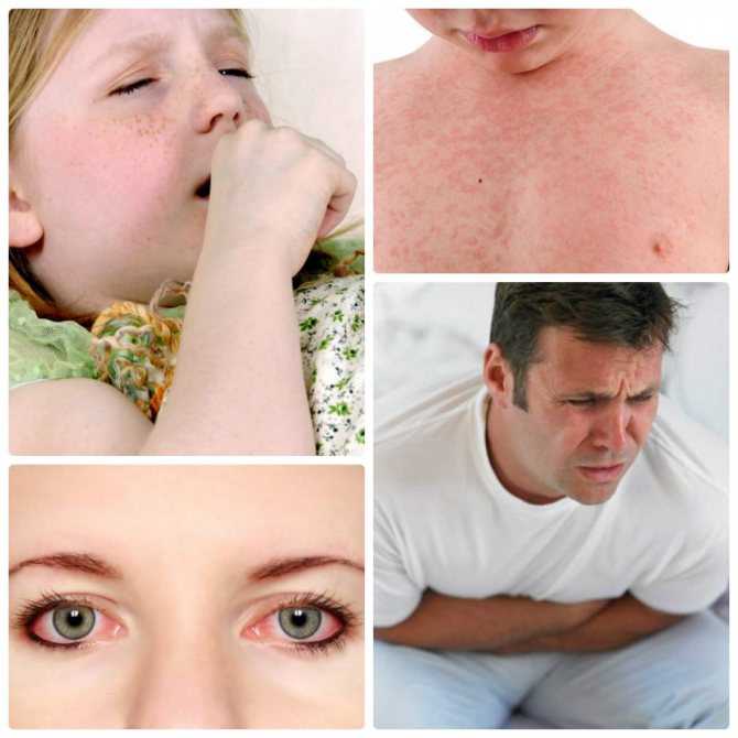 Лекарственная аллергия
